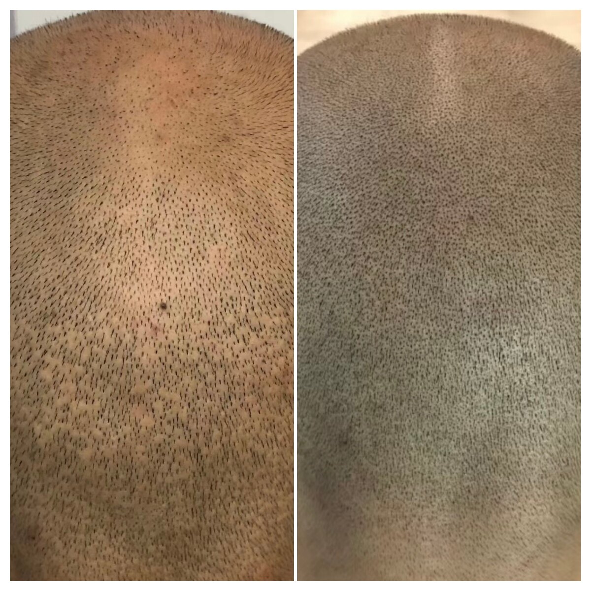 Scar Coverage