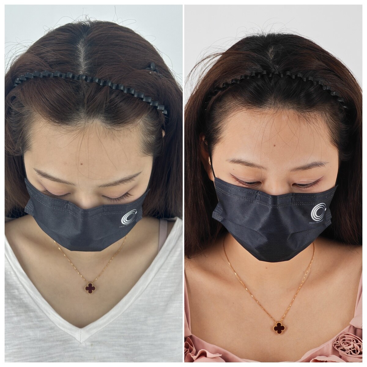 Hairline Restoration