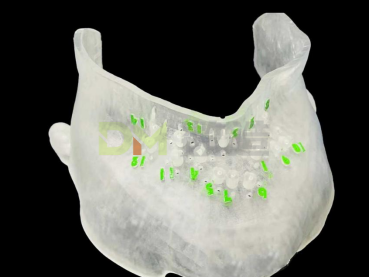 Digital Dental Restoration