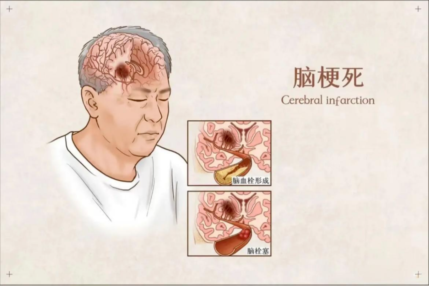 医生解剖多名脑梗死者，研究发现易患脑梗的人有6大共性
