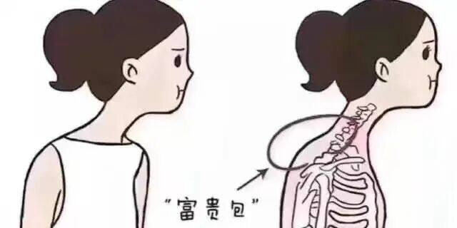 脖子后面的“富贵包”，究竟是怎么长出来的？