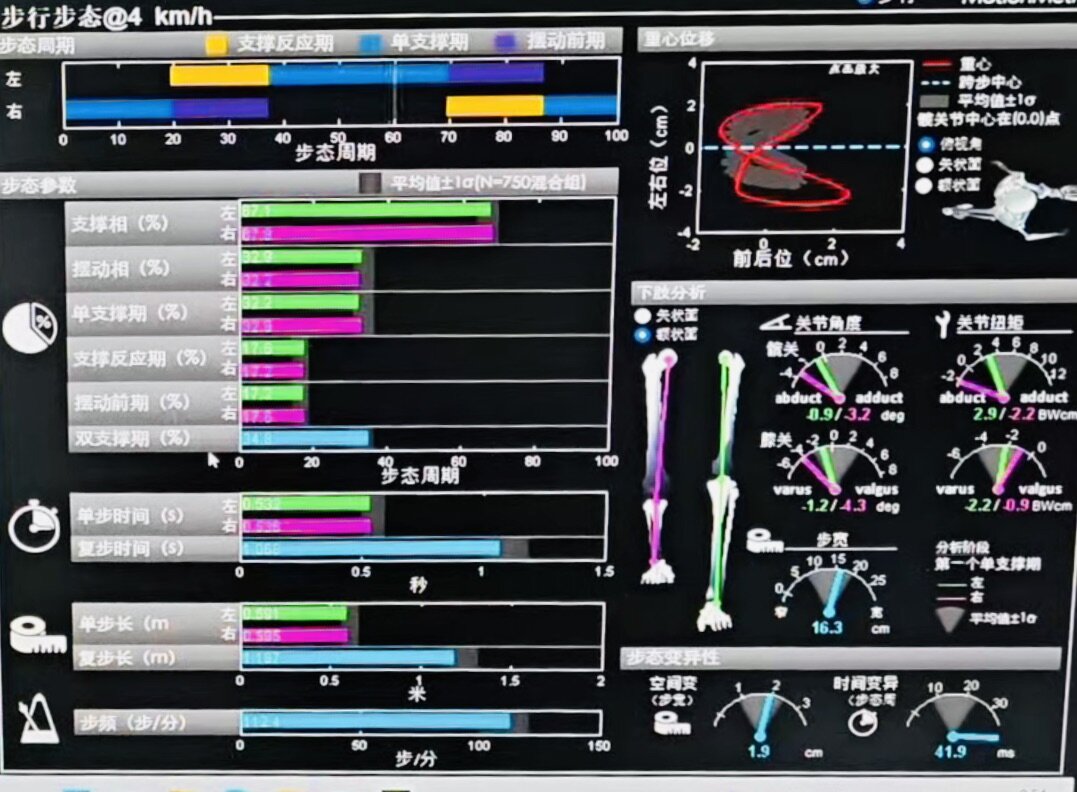 Gait Analysis: No Significant Difference Between Prosthetic and Sound Side