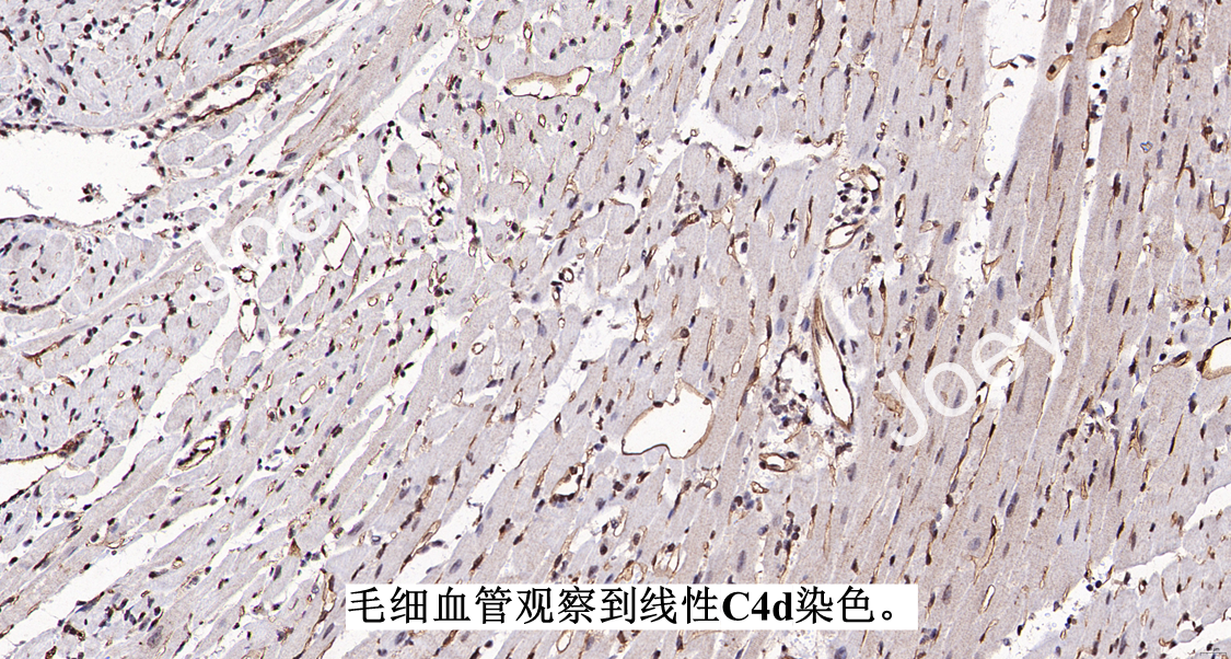 抗体介导的急性排斥反应 (C4d染色)