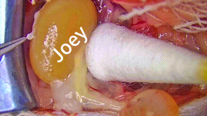 Kidney Transplant Procedure