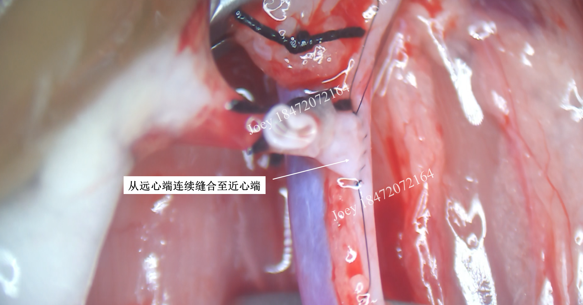 肾动脉端侧吻合