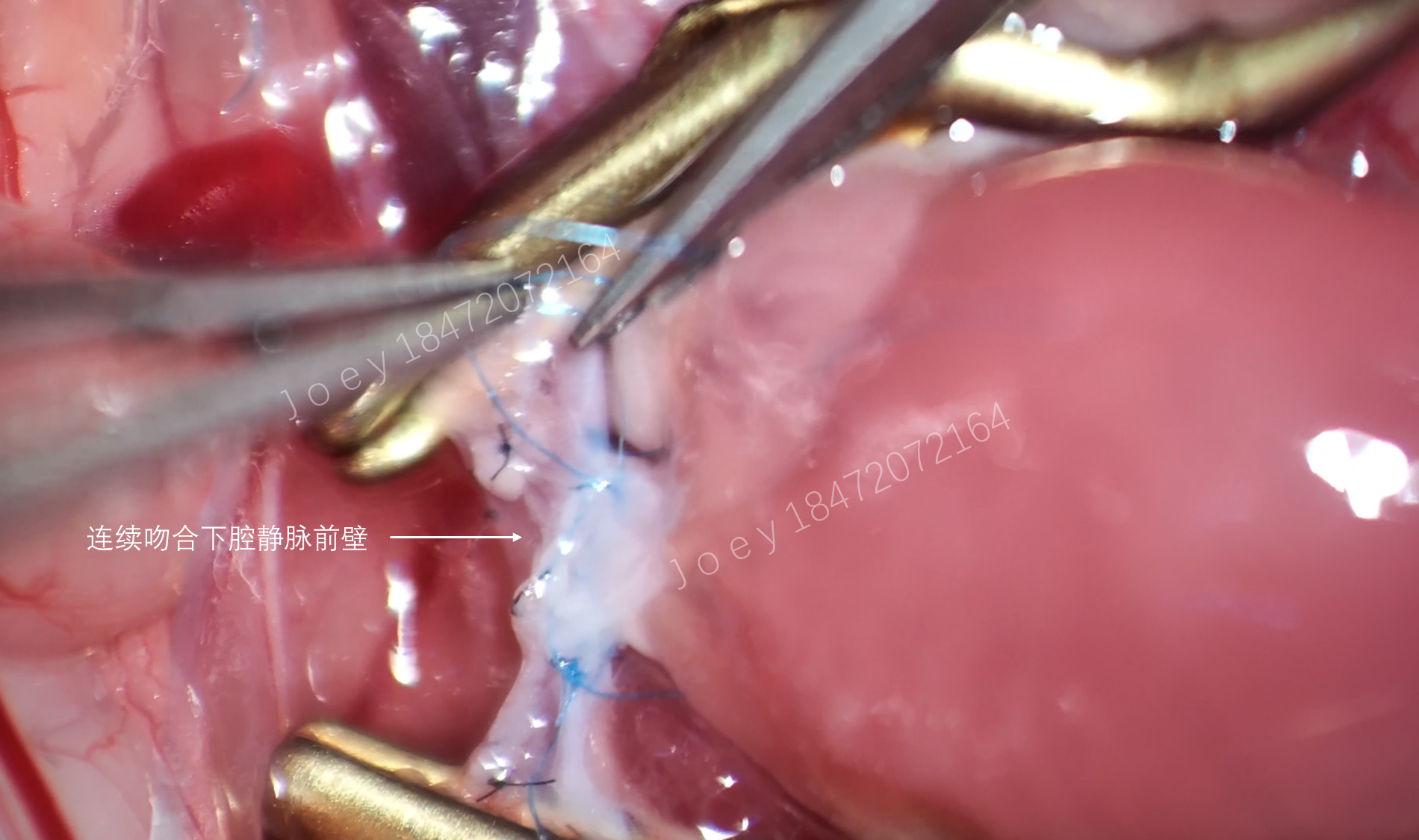 肺动脉端侧吻合