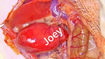 Heart Transplant Procedure