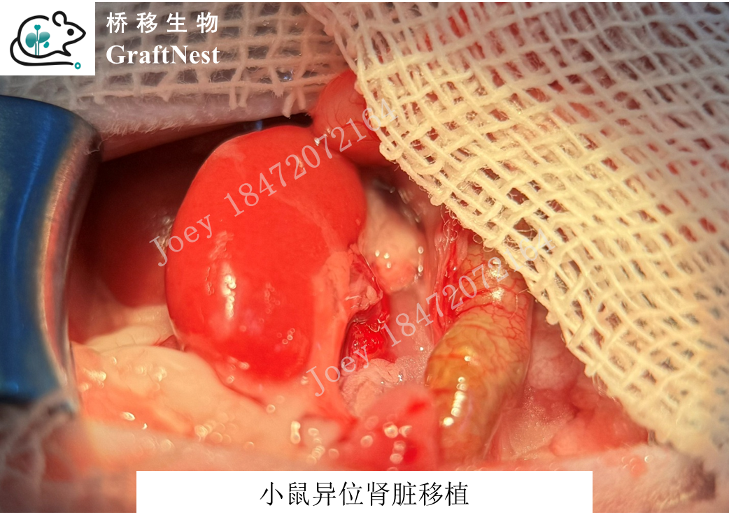 输尿管吻合与关腹