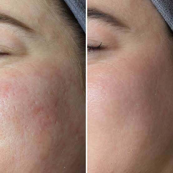 Before and After Microneedling - improved skin texture and reduced redness