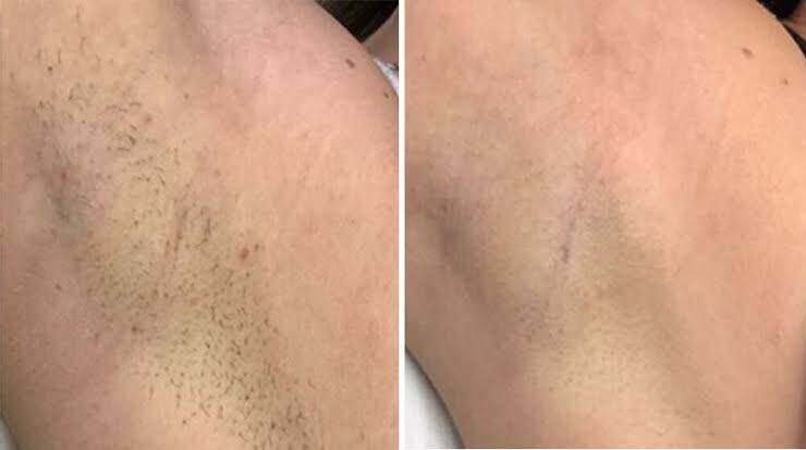 Before and After Underarm Laser Hair Removal