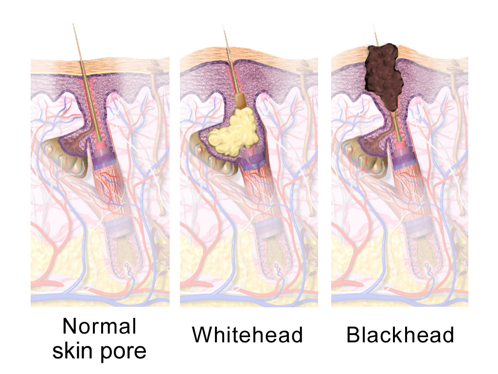 Pore types: Normal skin pore, Whitehead, Blackhead