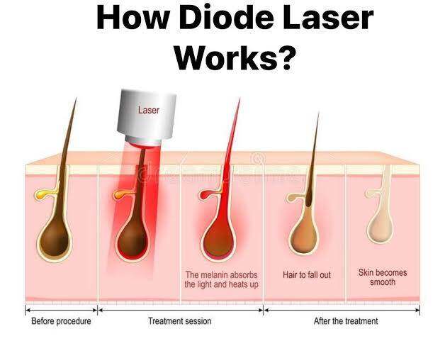 How Diode Laser Works - Before procedure, Treatment session, After the treatment