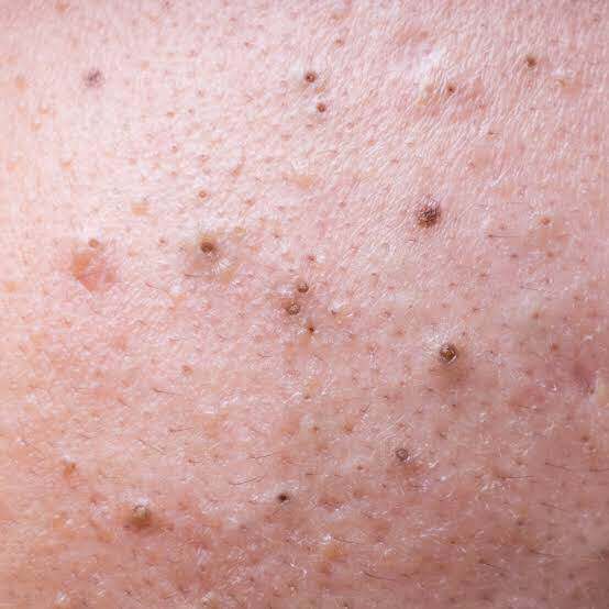 Close-up of skin with blackheads and clogged pores