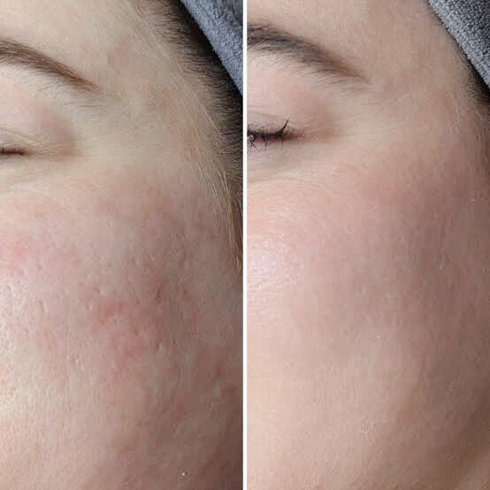 Acne Scars Treatment at DELUXE SPA & BEAUTY Yagoona