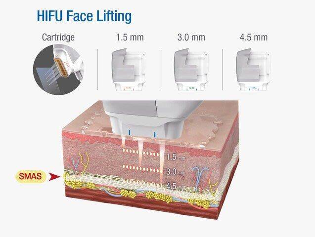 HIFU Face Lifting Technical Diagram - Cartridge depths 1.5mm, 3.0mm, 4.5mm targeting SMAS layer
