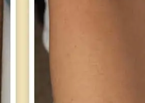 After laser hair removal at Three Sisters Beauty Burwood, showing smooth skin