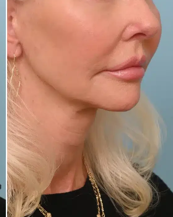 After HIFU face treatment at Three Sisters Beauty Burwood Sydney, showing lifted firmer skin