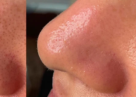 After HydraFacial Deep Pore Cleansing treatment at Deluxe Spa & Beauty Yagoona