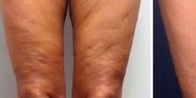 Before HIRE HIFU Arms Contouring treatment at Deluxe Spa & Beauty Yagoona