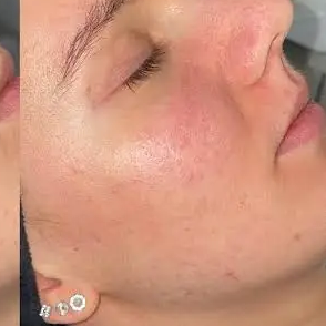 After acne blemish control facial at Three Sisters Beauty Burwood Sydney, showing improved clear complexion