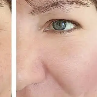 After HIRE HIFU Eye Lifting Treatment treatment at Deluxe Spa & Beauty Yagoona