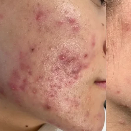 Before Advanced Acne Blemish Correction treatment at Deluxe Spa & Beauty Yagoona