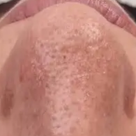 Before Hydrafacial deep clean treatment at Three Sisters Beauty Burwood, showing skin texture and pores