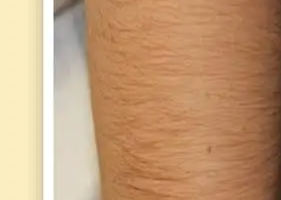 Before laser hair removal at Three Sisters Beauty Burwood