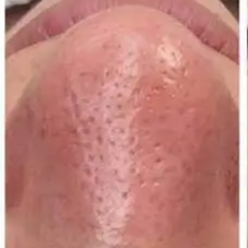 After Hydrafacial deep clean treatment at Three Sisters Beauty Burwood, showing clearer smoother skin