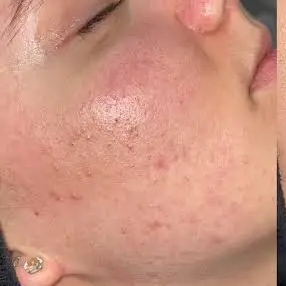 Before acne blemish control facial at Three Sisters Beauty Burwood Sydney, showing blemished skin