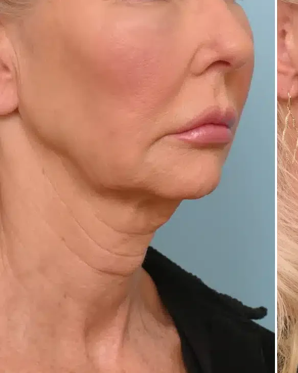 Before HIFU face treatment at Three Sisters Beauty Burwood Sydney, showing sagging skin and fine lines