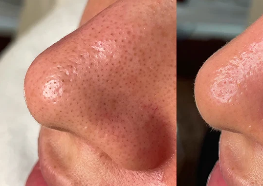Before HydraFacial Deep Pore Cleansing treatment at Deluxe Spa & Beauty Yagoona