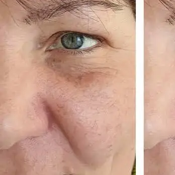 Before HIRE HIFU Eye Lifting Treatment treatment at Deluxe Spa & Beauty Yagoona