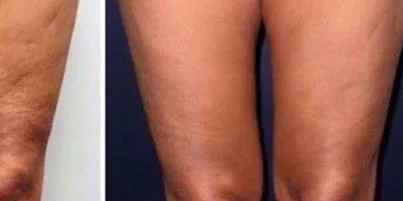 After HIRE HIFU Arms Contouring treatment at Deluxe Spa & Beauty Yagoona