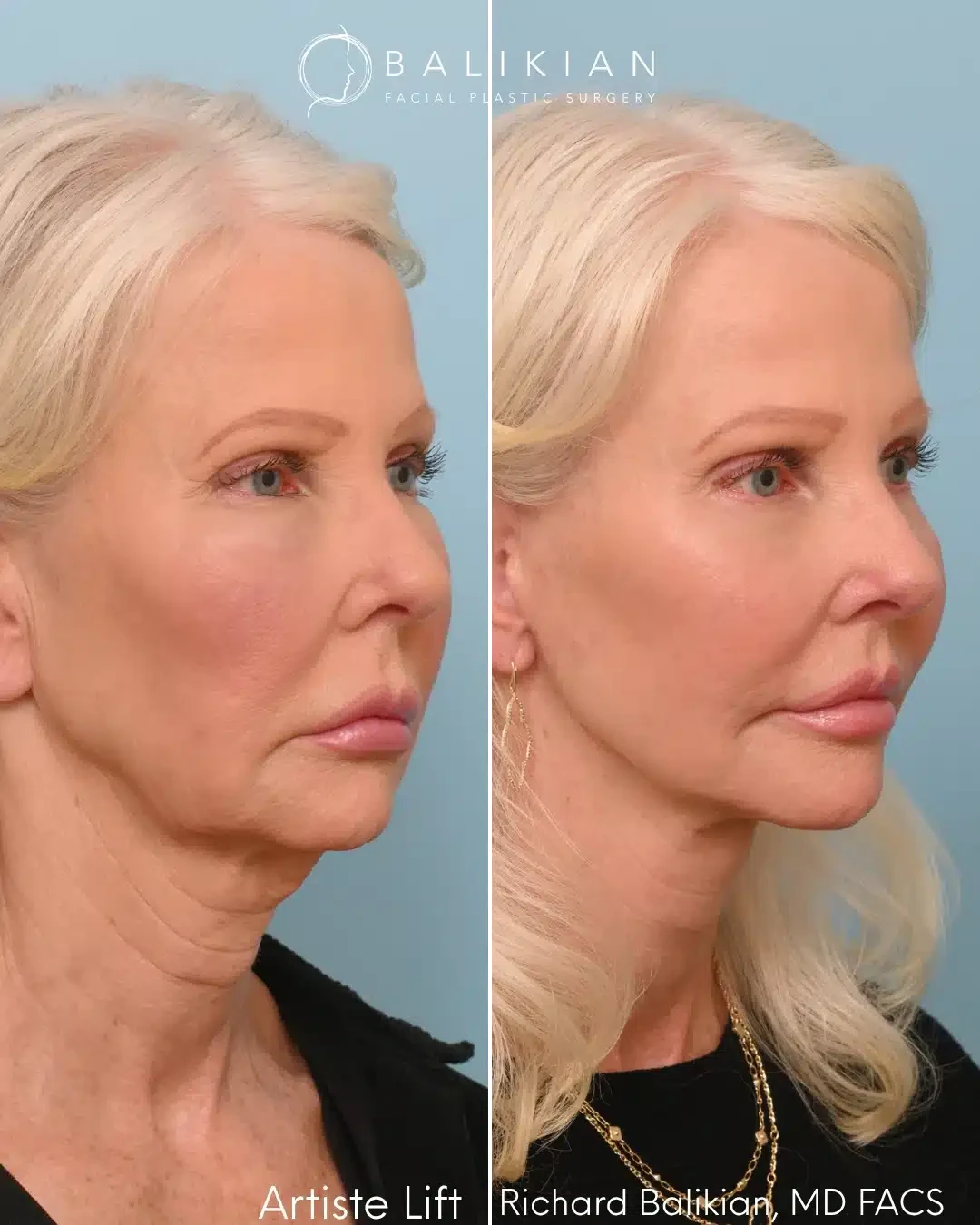 10D HIFU full face neck and facial package deal at Three Sisters Beauty Burwood Sydney