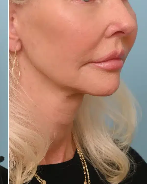 After HIRE HIFU Advance Full Face Lift treatment at Deluxe Spa & Beauty Yagoona
