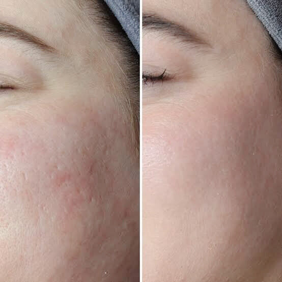 Microneedling
