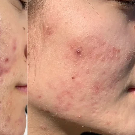 After Advanced Acne Blemish Correction treatment at Deluxe Spa & Beauty Yagoona