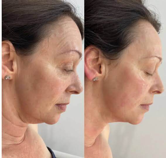 Promotion HIRE HIFU Face + Neck