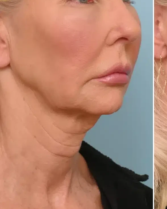Before HIRE HIFU Advance Full Face Lift treatment at Deluxe Spa & Beauty Yagoona