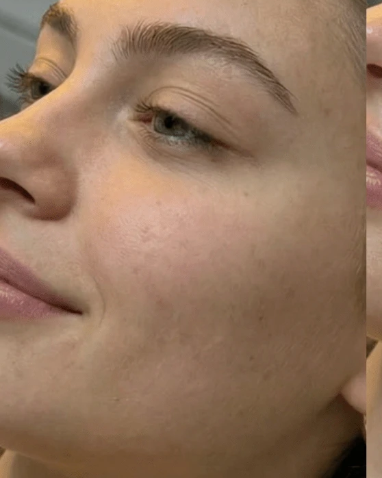 Before oxygen glass skin facial treatment at Three Sisters Beauty Burwood, showing dull dehydrated skin