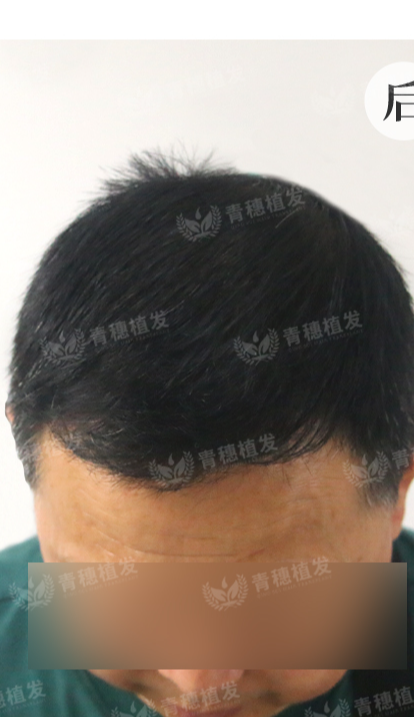 术后