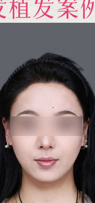 术后