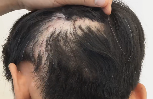 疤痕性脱发