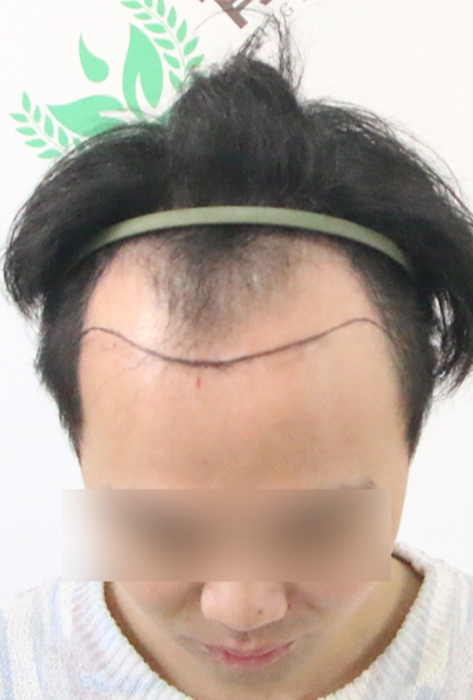 术前