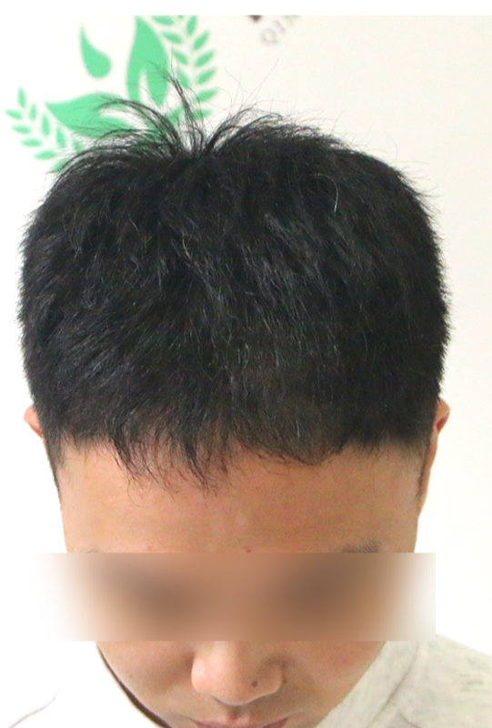 术后