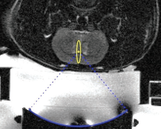 MRI-guided system
