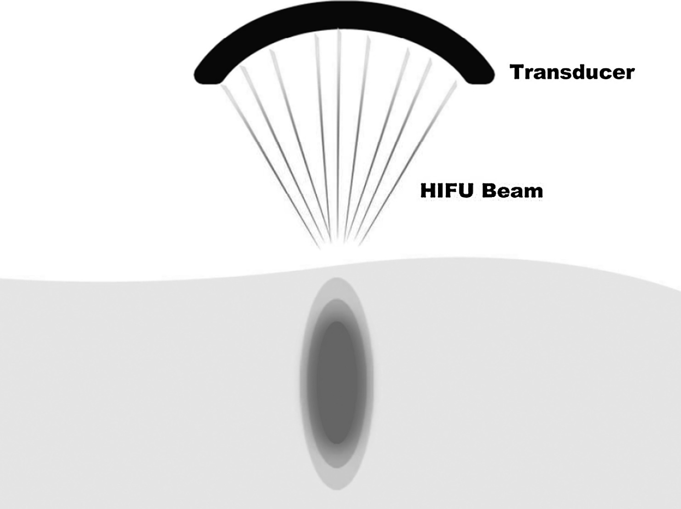 Principle of High-Intensity Focused Ultrasound