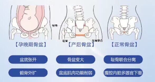 成都产后修复_骨盆体态调整孕期产后正常骨盆对比图