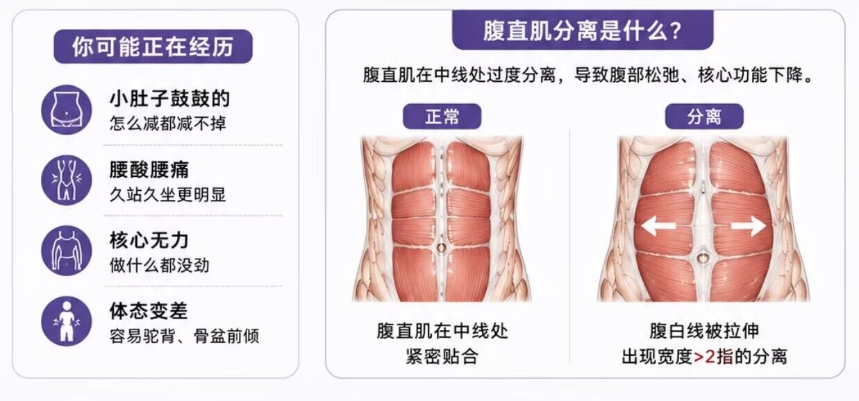 成都产后修复_腹直肌分离自测方法与程度分级图